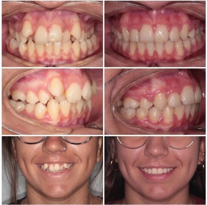 antes despues orotdoncia alameda clinica dental
