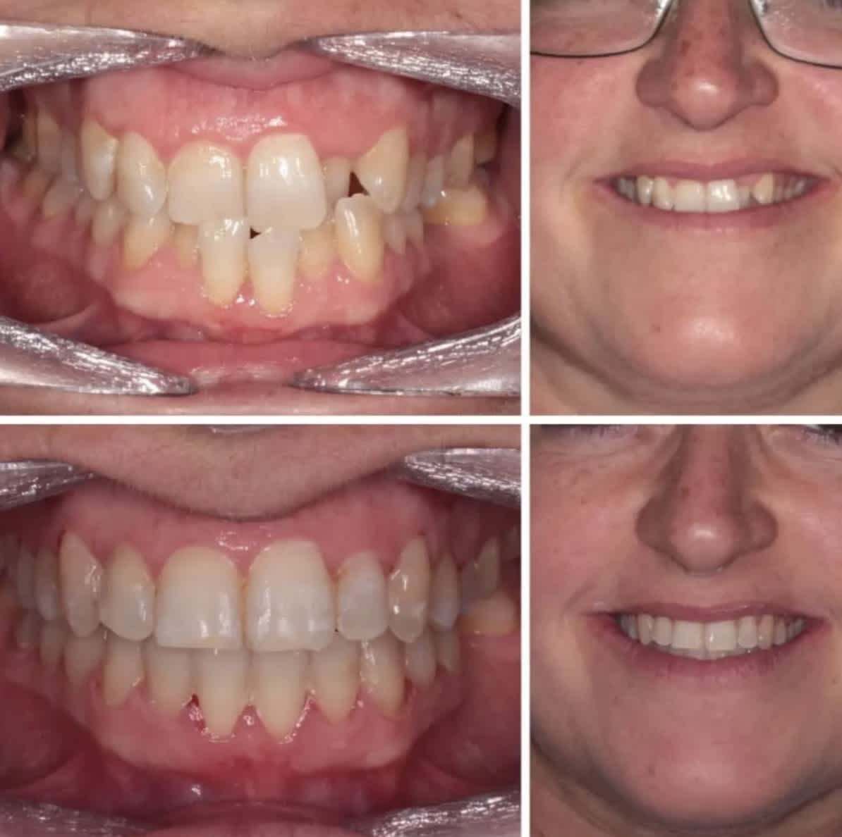 ortodoncia en alameda resultados