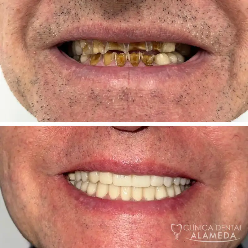 antes despues implantes dentales clinica alameda 1