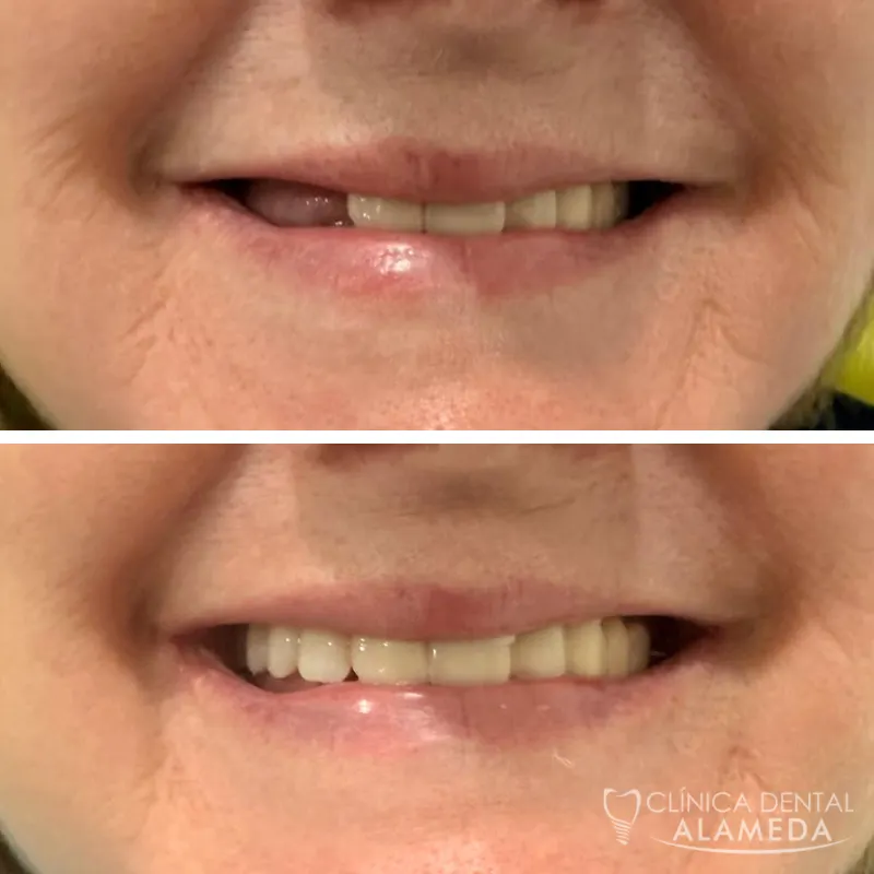 antes despues implantes dentales clinica alameda 2